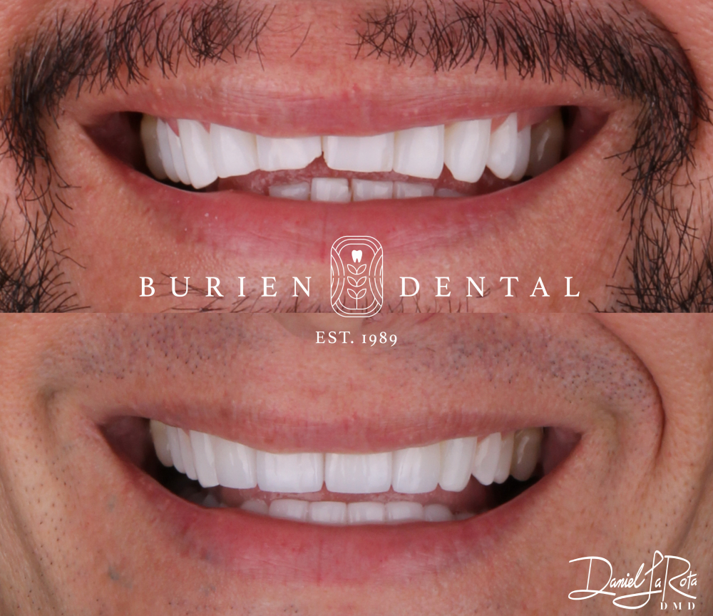 Before and after dental treatment showing stained upper teeth corrected to a brighter, even smile at Burien Dental.