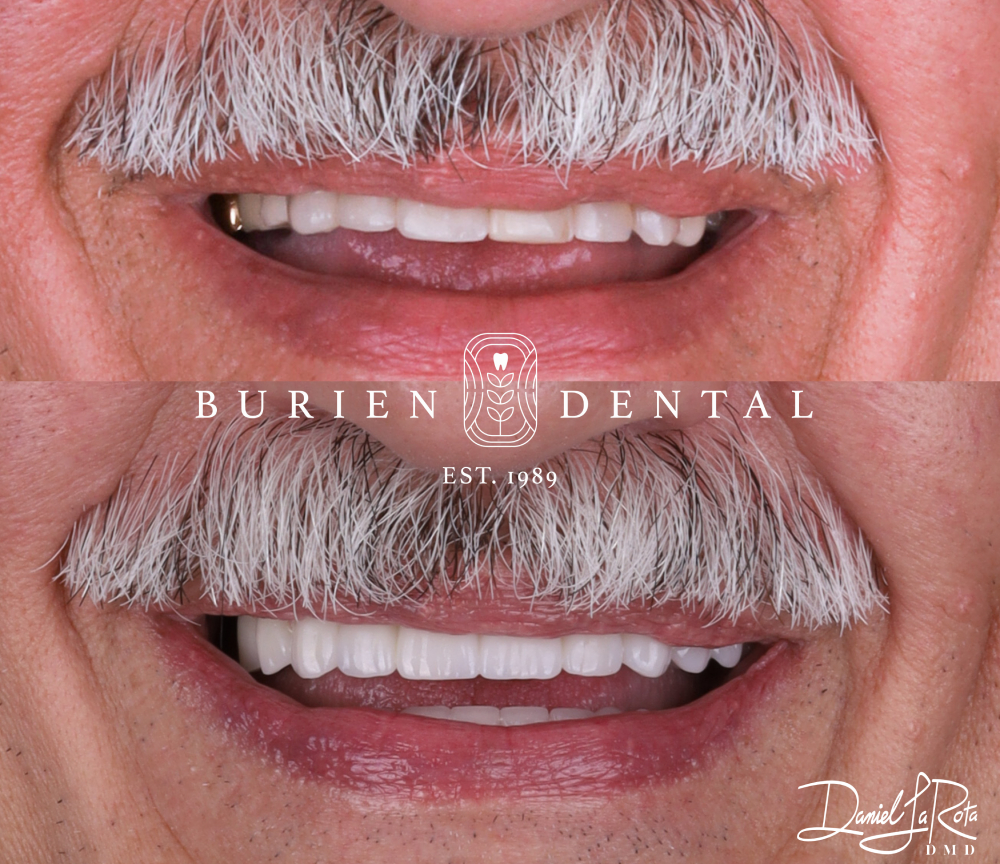 Before photo with yellowed, uneven teeth next to an after photo featuring smooth, natural-looking veneers.