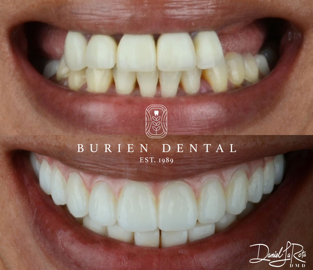Patient smile improvement from discolored enamel to clean, uniform teeth after cosmetic dentistry at Burien Dental.