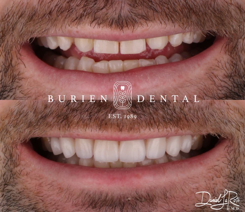Smile makeover progression showing chipped and darkened teeth restored to a bright, healthy appearance.