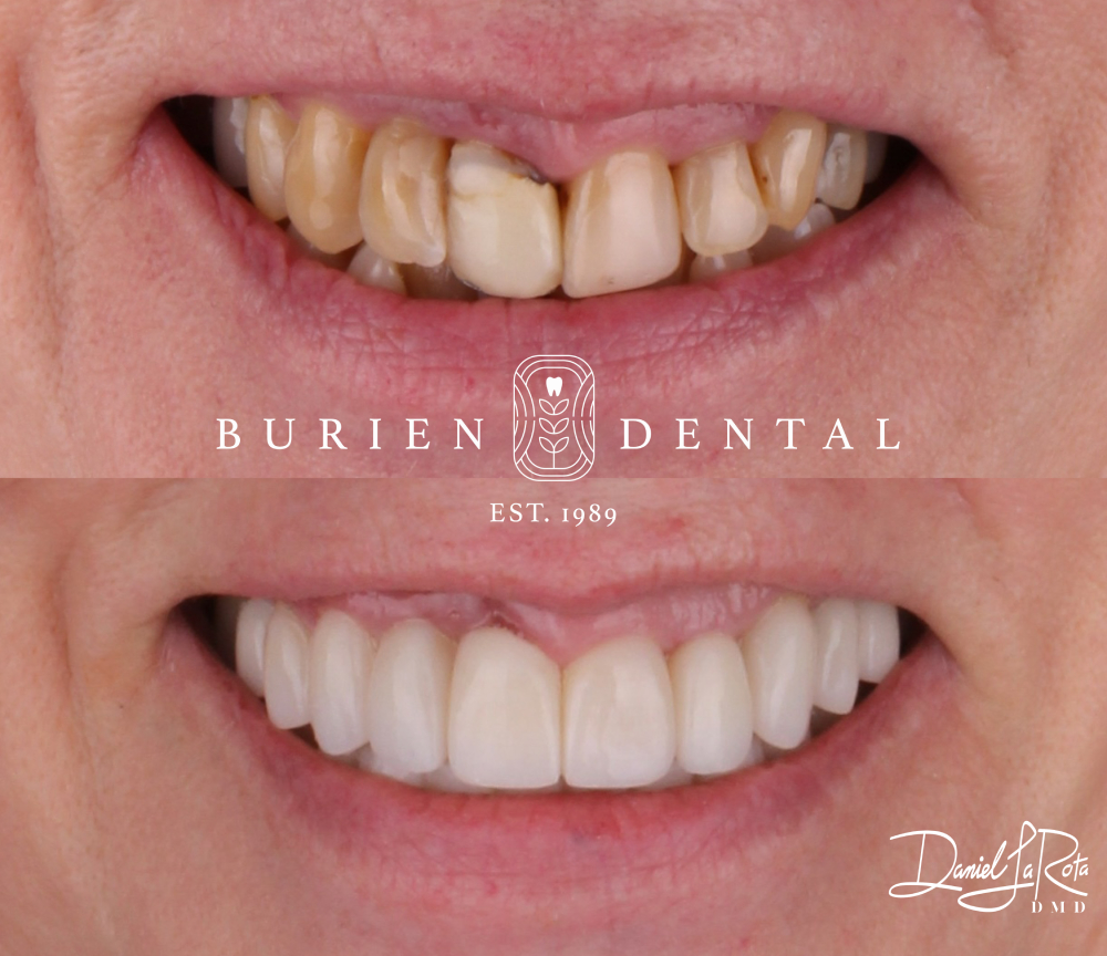 Transformation of a patient’s smile from worn, discolored teeth to a smooth, bright, and aligned finish.